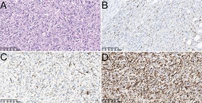 Clinicopathological characteristics and outcome of primary sarcomatoid carcinoma of the gallbladder